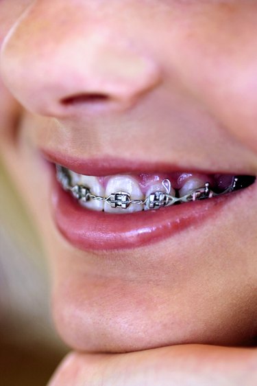 Affordable Braces Options: Financial Assistance & Payment Plans