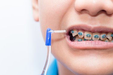 Affordable Braces for Kids: Financial Assistance Options